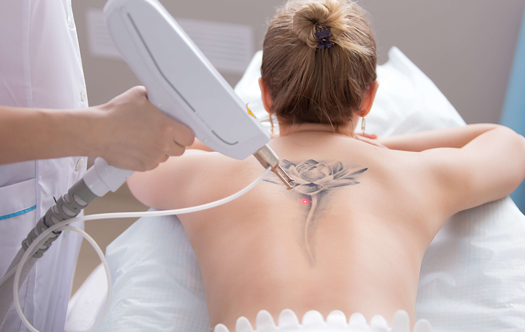 Laser Tatoo Removal